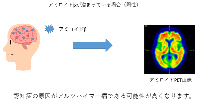 アミロイドPETの説明図1