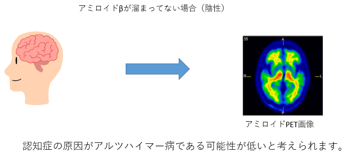 アミロイドPETの説明図2